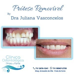 Prótese removível. Os melhores cuidados com sua sáude bucal em Praia do Forte