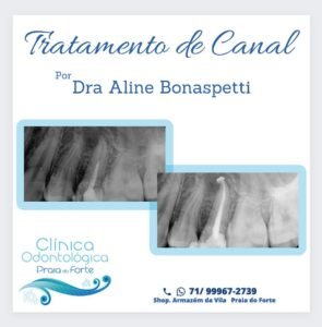 Tratamento e Canal em Sessão Única em Praia do Forte.. Os melhores cuidados com sua sáude bucal em Praia do Forte