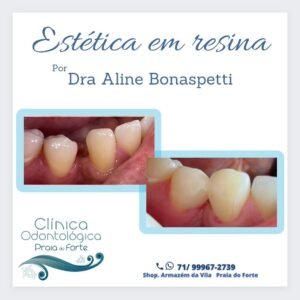 Estética em Resina em Praia do Forte.Os melhores cuidados com sua sáude bucal em Praia do Forte