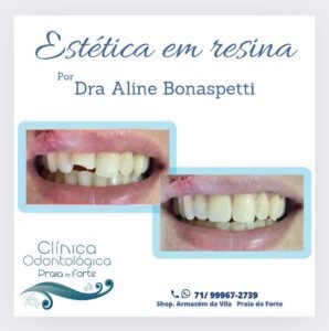 Estética em resina em Praia do Forte. Os melhores cuidados com sua sáude bucal em Praia do Forte